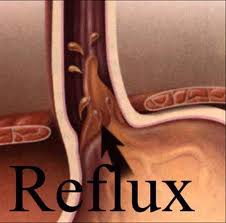 a reflux súlycsökkenést okozhat
